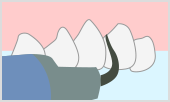 歯石・歯垢の除去